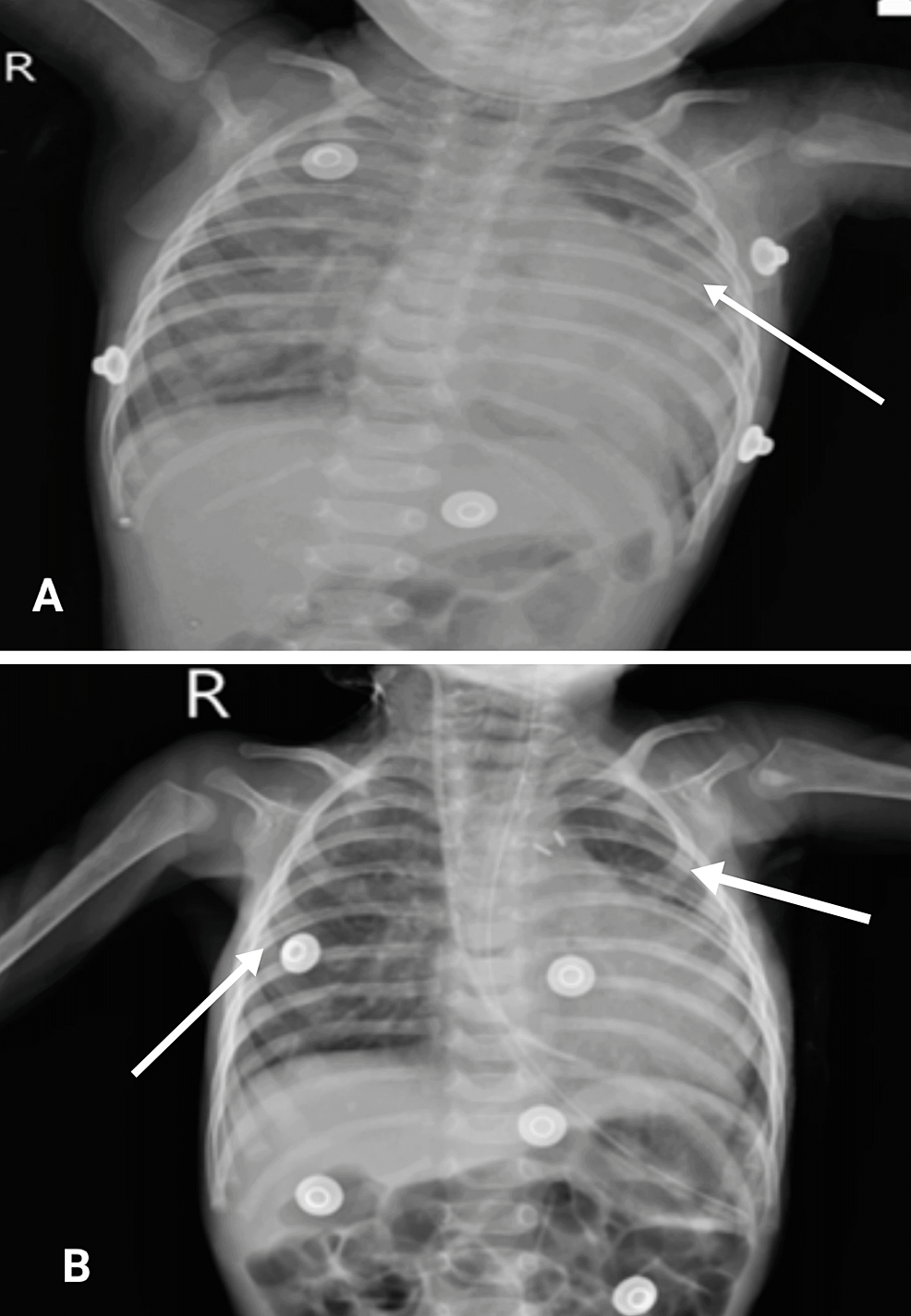 -Chest-Radiograph