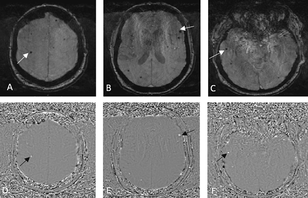 Cureus Acute Disseminated Encephalomyelitis Following Thoracic Endovascular Aortic Repair