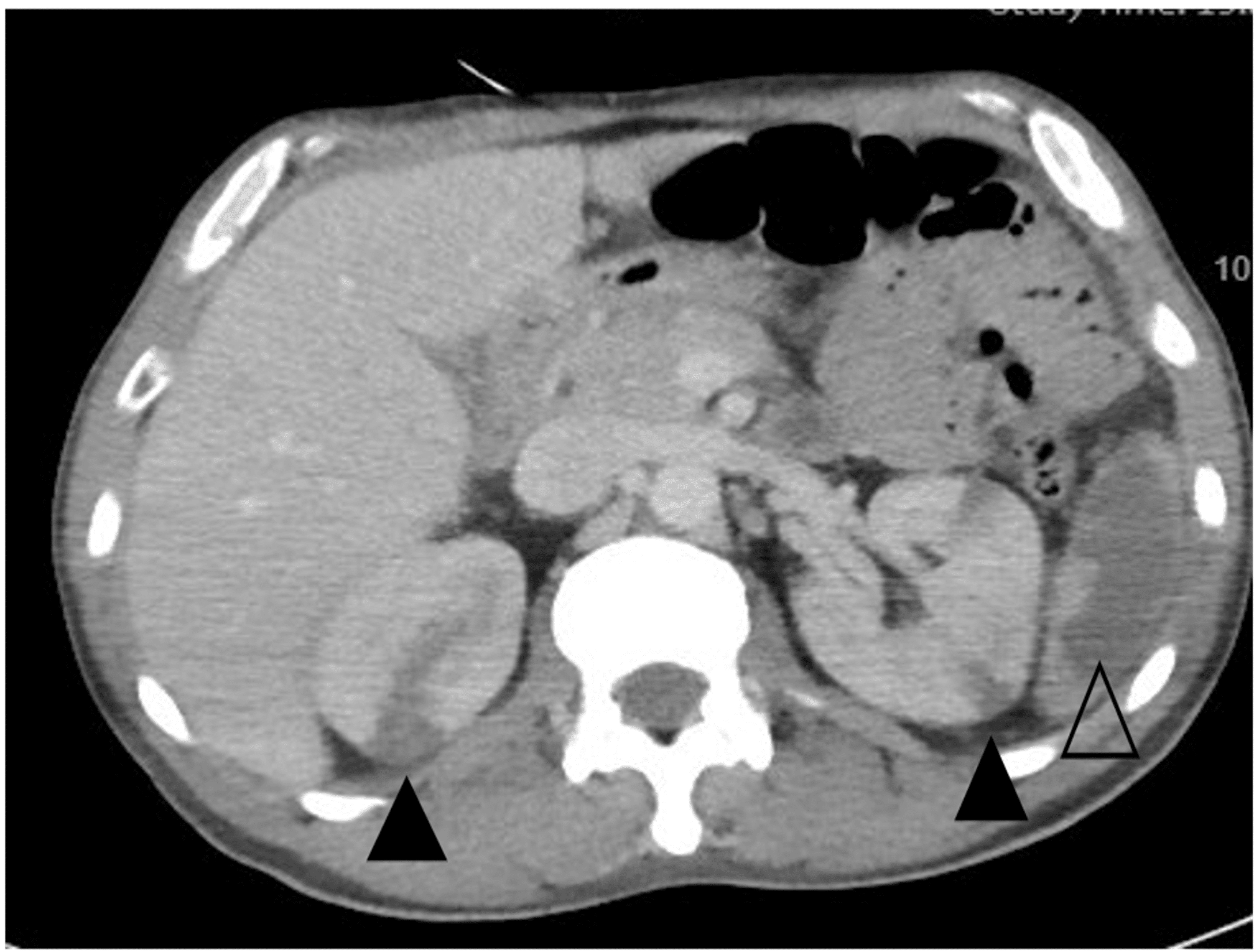 Cureus | Granulomatosis With Polyangiitis Complicated by Diffuse ...