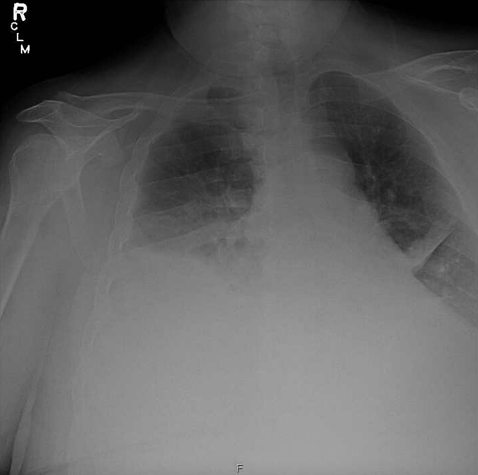 Chylous Ascites Developing Into Bilateral Chylothorax in HighGrade