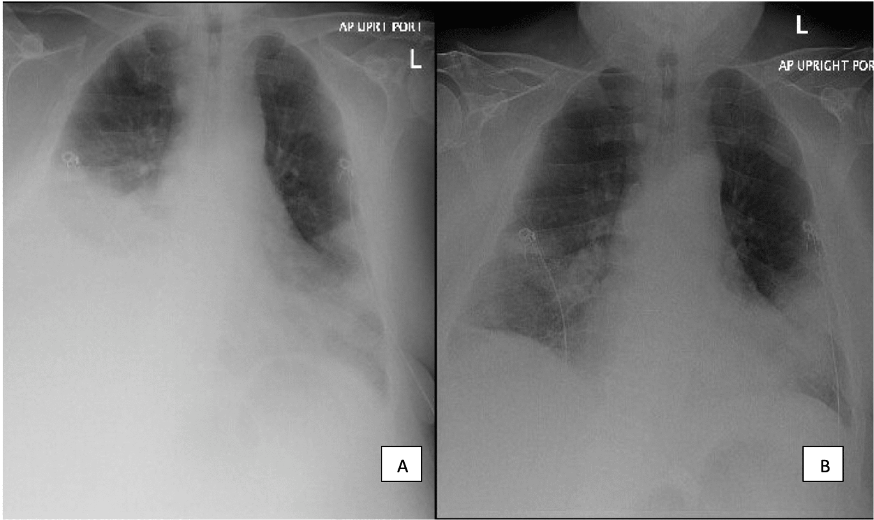 Chylous Ascites Developing Into Bilateral Chylothorax in HighGrade