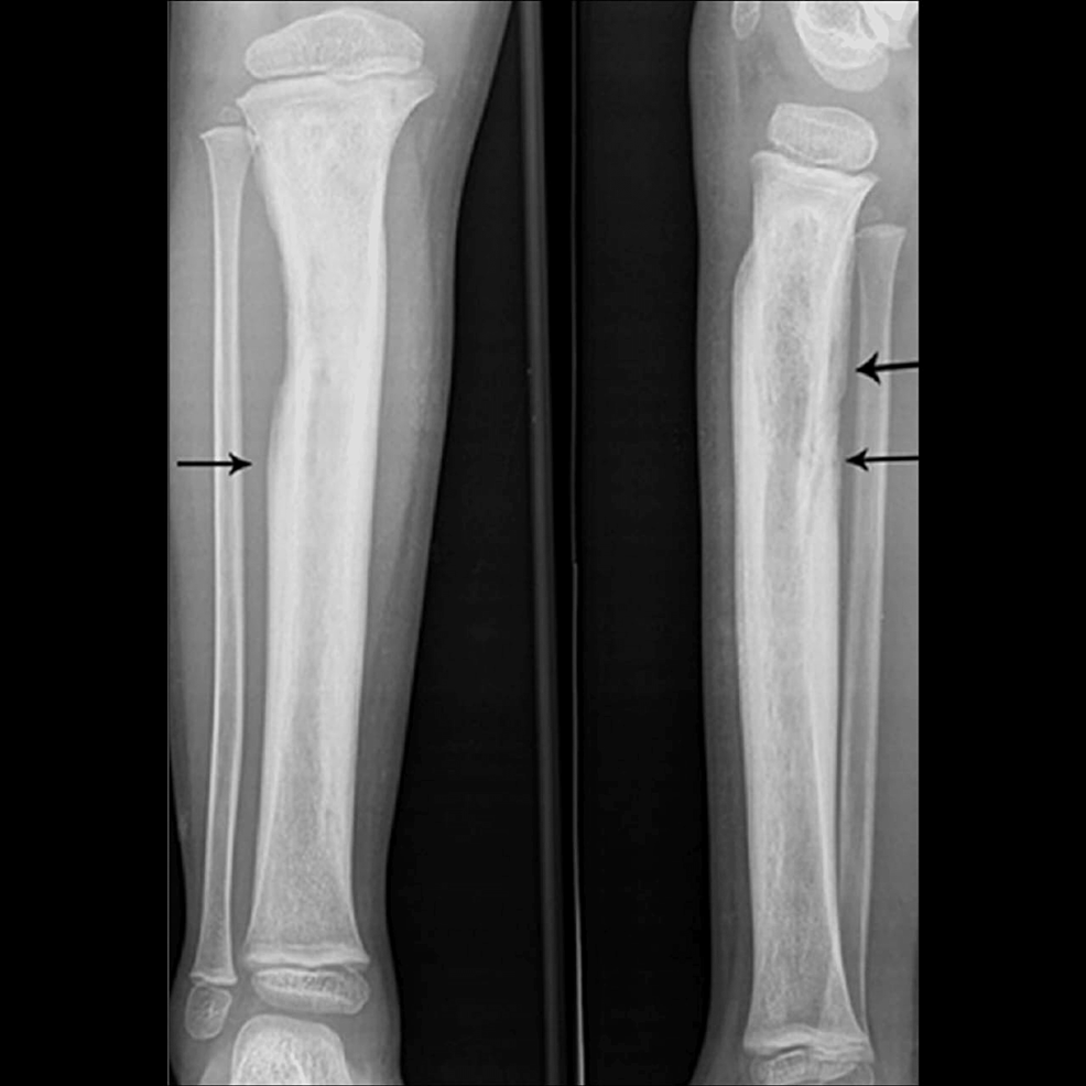 Osteomyelitis X Ray Jaw vrogue.co