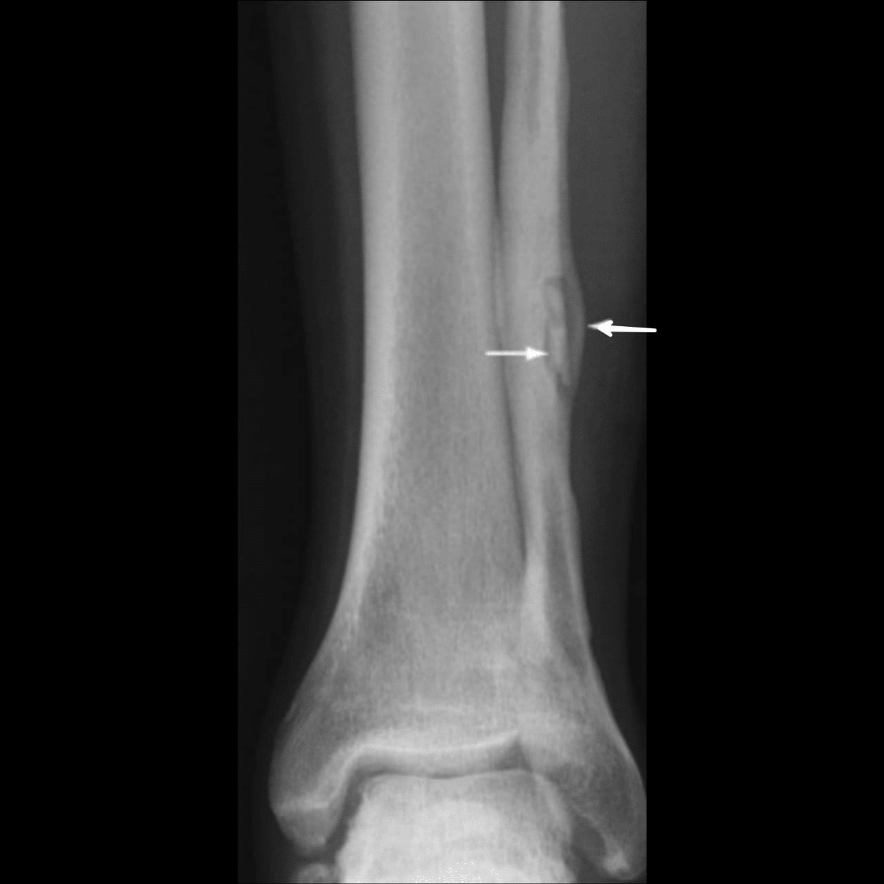 Cureus Diagnosis and Treatment Modalities for Osteomyelitis
