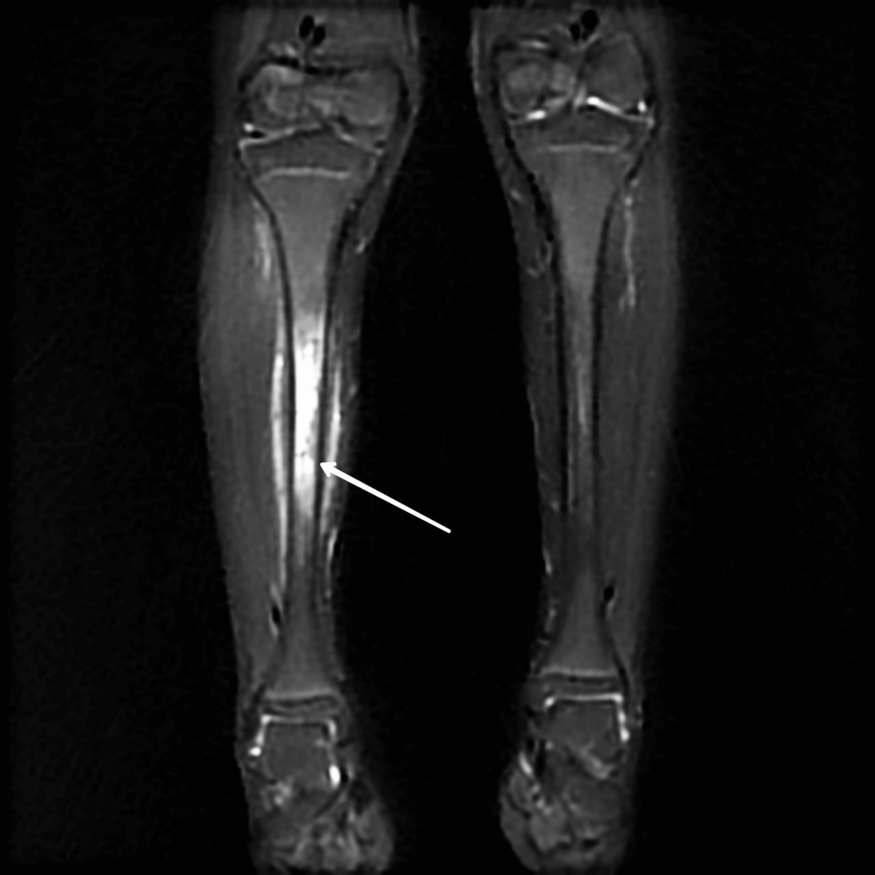 Cureus Diagnosis And Treatment Modalities For Osteomyelitis