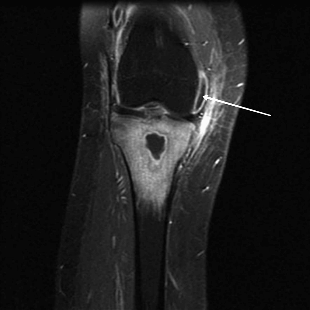 Cureus Diagnosis And Treatment Modalities For Osteomyelitis