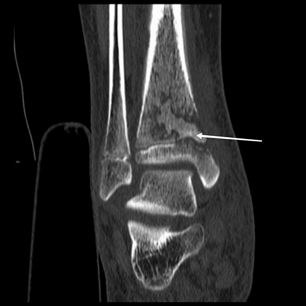 Diagnosis and Treatment Modalities for Osteomyelitis Cureus