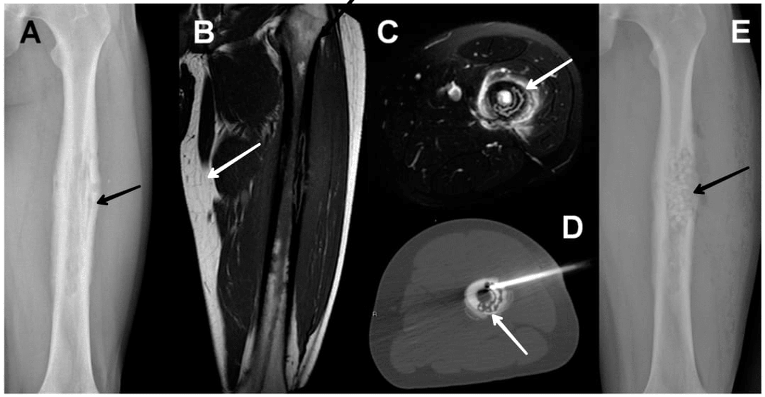 Diagnosis and Treatment Modalities for Osteomyelitis Cureus