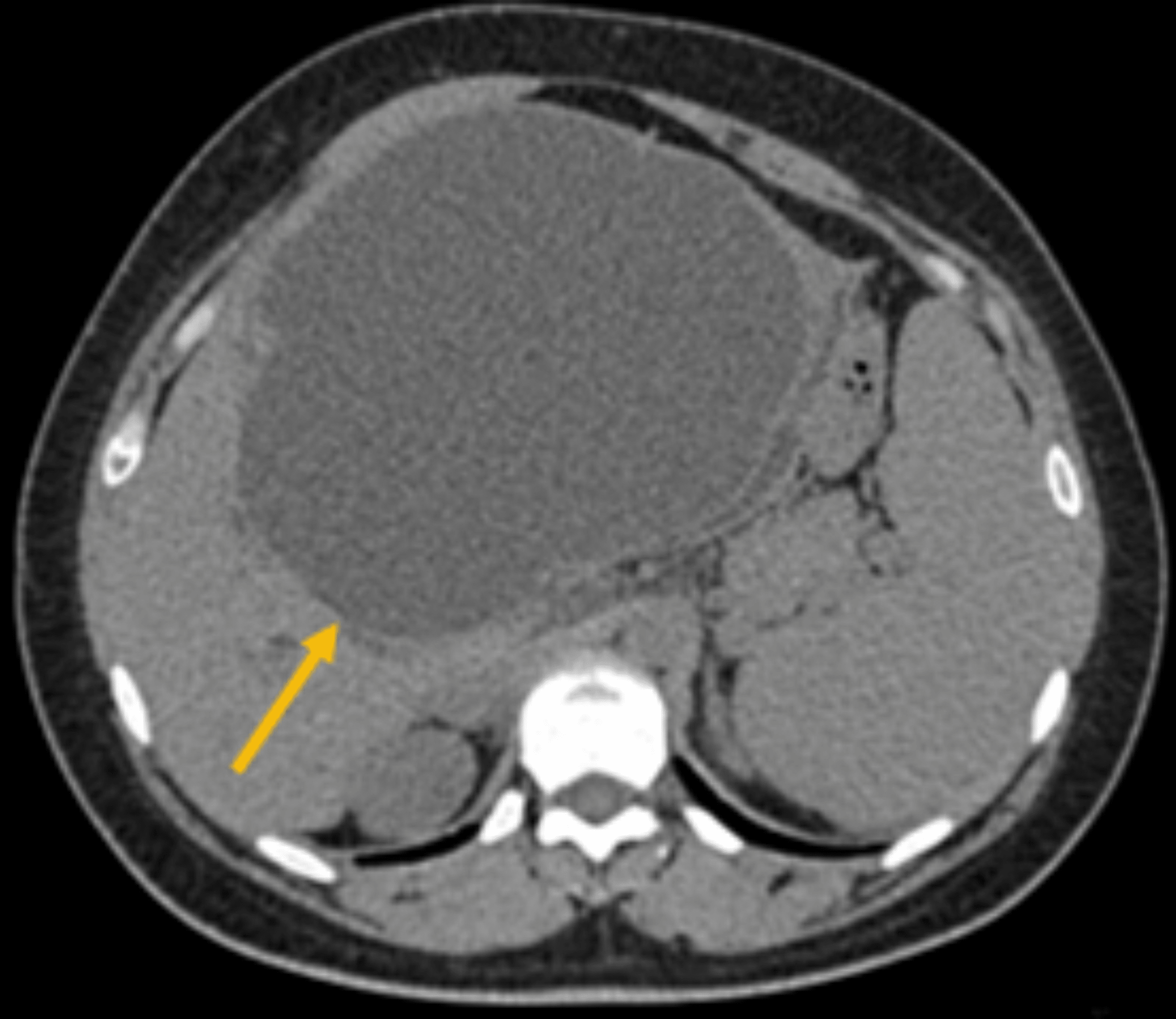 Cureus Liver Mucinous Cystic Neoplasm With Obstructive Jaundice