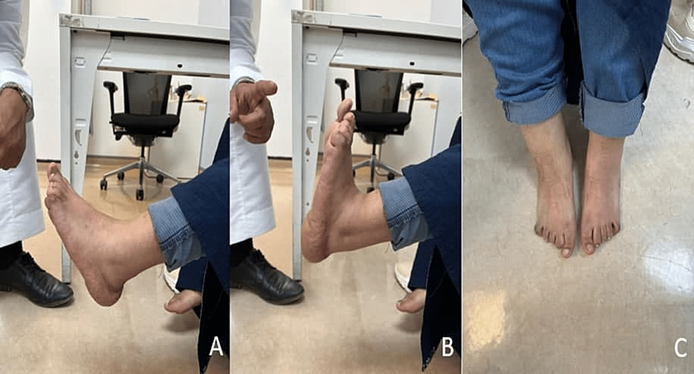 Cureus Chronic Calcaneovalgus Deformity Treated With Tibialis