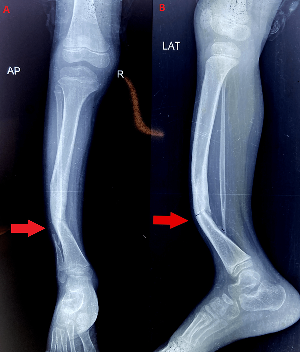 Cureus, Congenital Pseudoarthrosis of Tibia With Anterolateral Bowing  Treated With Ilizarov Ring Fixator: A Case Report