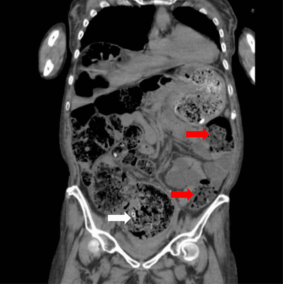 Cureus Stercoral Colitis as a Cause of Altered Mental Status in a