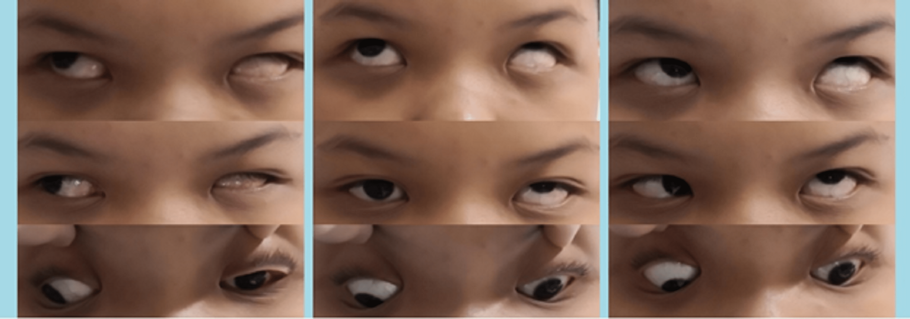 Cureus Duane Retraction Syndrome With Mechanical and Innervational