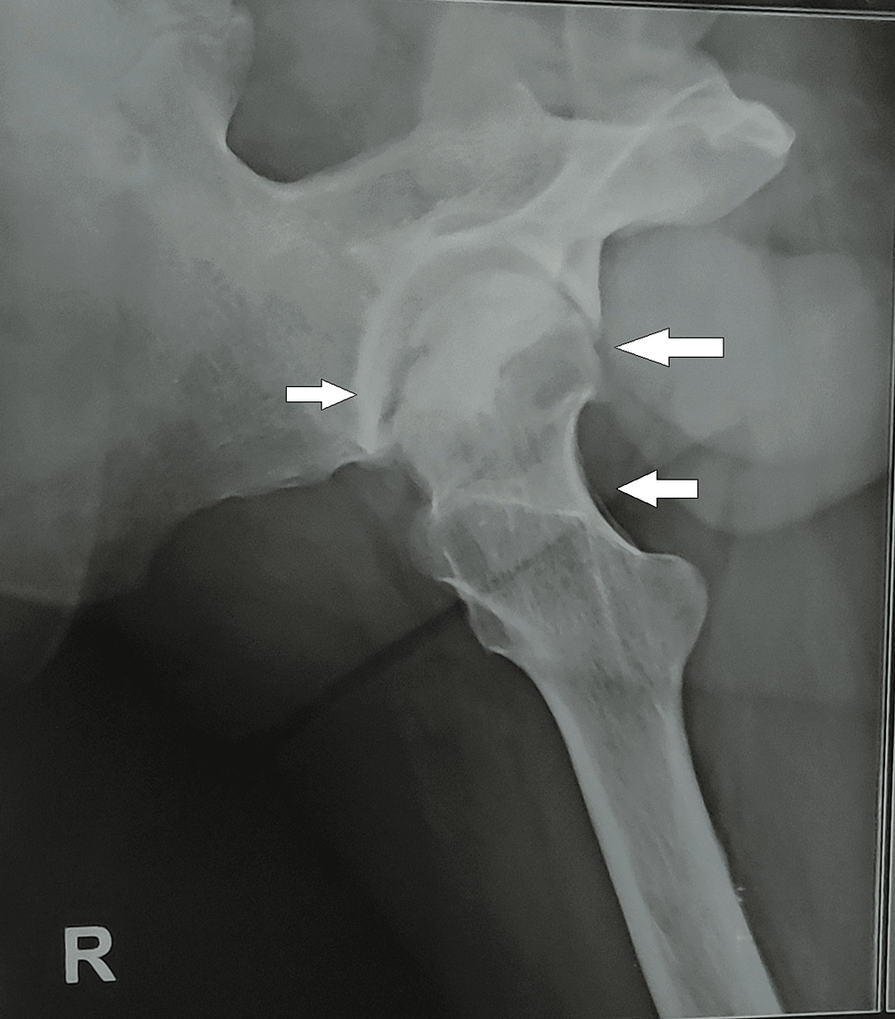 Physiotherapy Rehabilitation Post Total Hip Replacement In The Case Of Avascular Necrosis Of The 8135