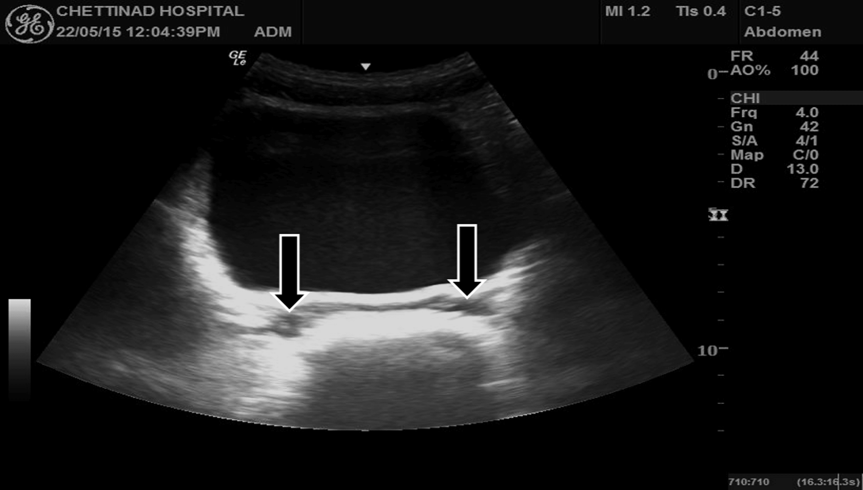 Cureus Zinner Syndrome