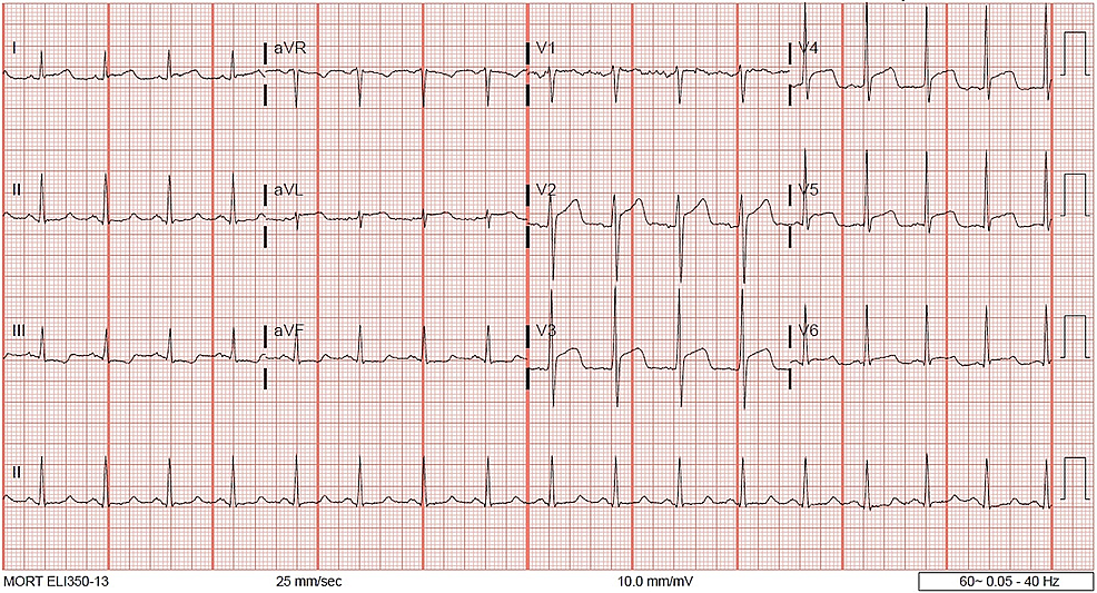 Cureus | Accelerated Idioventricular Rhythm at the Termination of an ...