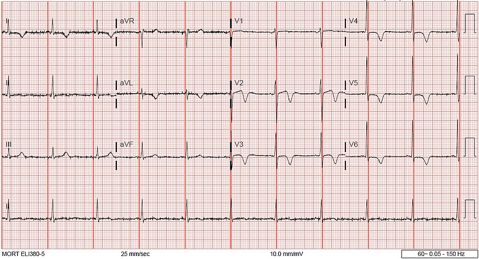 interpretation-of-t-wave-inversion-in-physiological-and-pathological