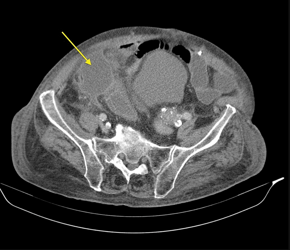 cureus-spontaneous-gallbladder-perforation-a-case-report