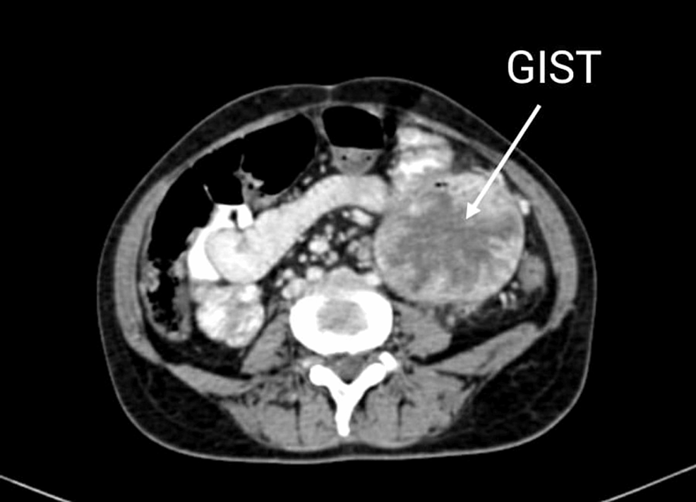 If You Have a Gastrointestinal Stromal Tumor (GIST)