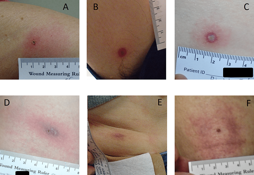 Lesions-reviewer-classified-as-(A)-possible-early-EM;-(B-F)-tick-bite-reactions