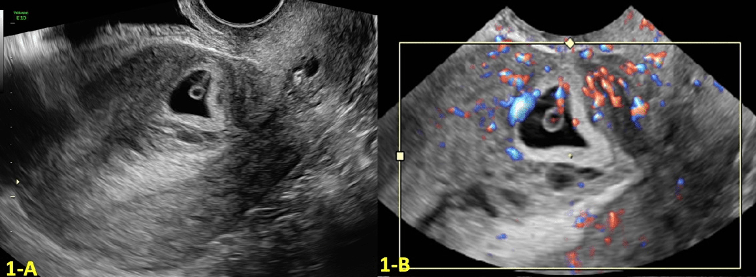 Cureus Sonographic Diagnosis And Management With Delayed Hysterectomy