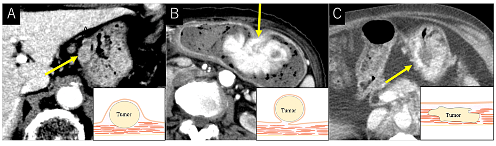 Cureus | Clinicoradiological Characteristics of Gastric Metastases: A ...