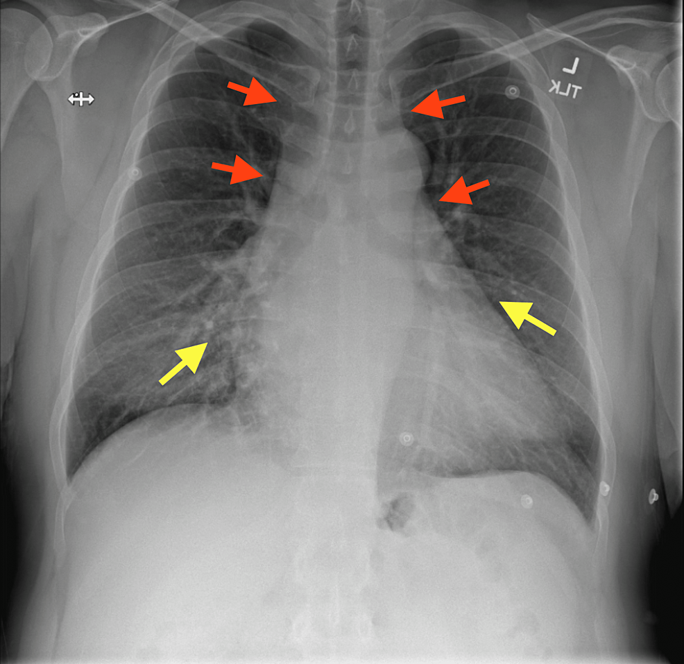 Cureus | Type A Aortic Dissection Presenting as Acute Coronary Syndrome ...