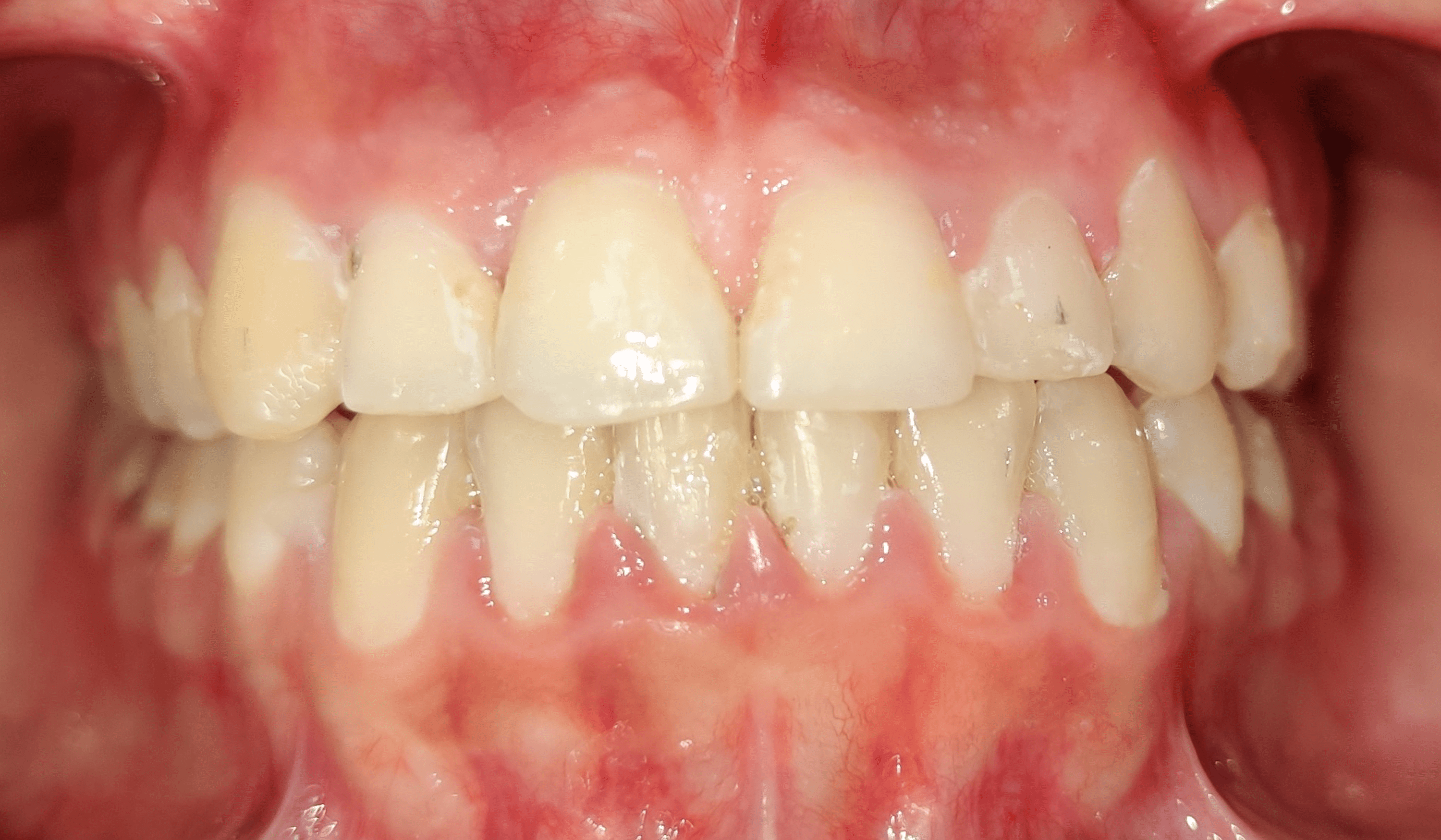 Cureus Multidisciplinary Approach to Treatment of Midline Diastema