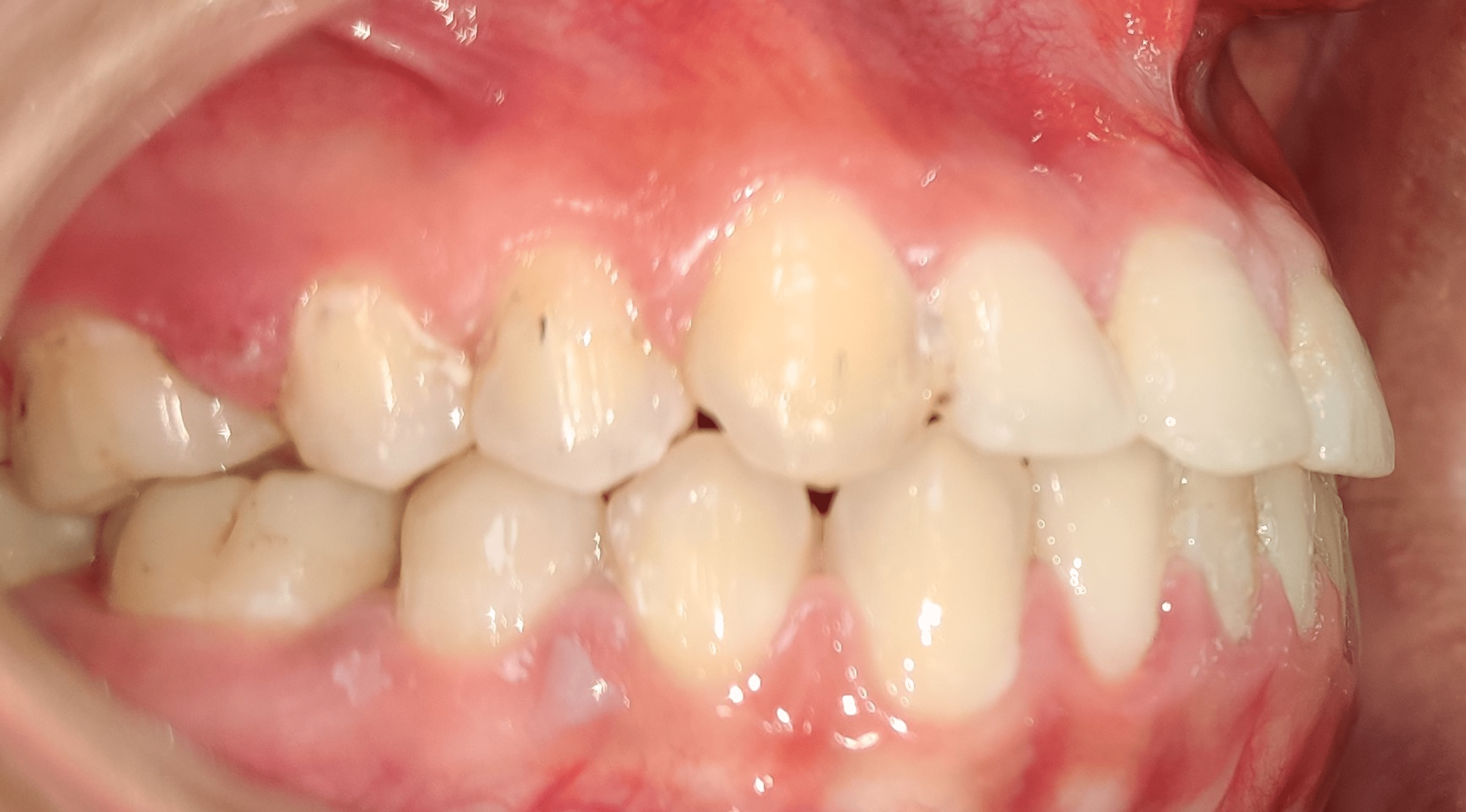 Cureus Multidisciplinary Approach to Treatment of Midline Diastema