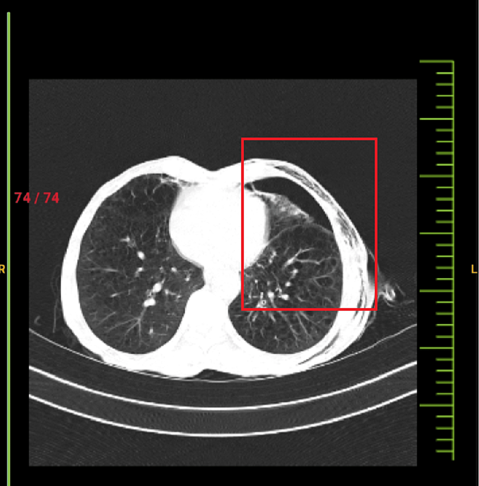 CT-Thorax-presenting-pneumothorax-with-underlying-lung-atelectasis