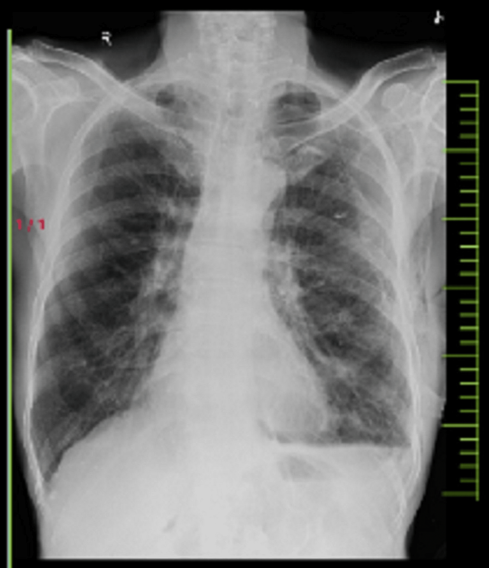 Posterior-anterior-view-of-chest-X-ray-showing-tracheal-deviation-and-flattening-of-left-hemidiaphragm