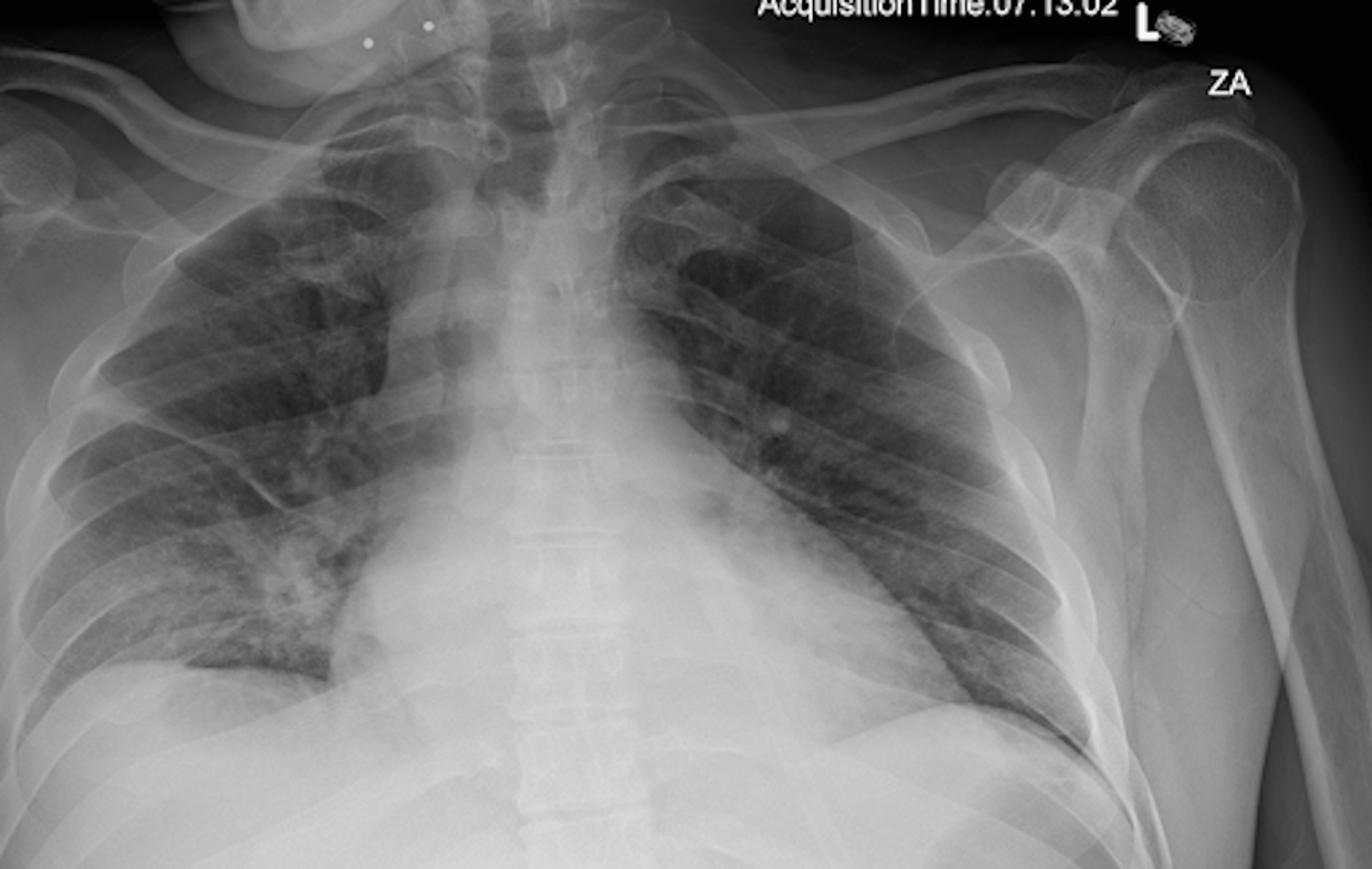 Dysphagia Lusoria Causing Aspiration Pneumonitis in a Patient With