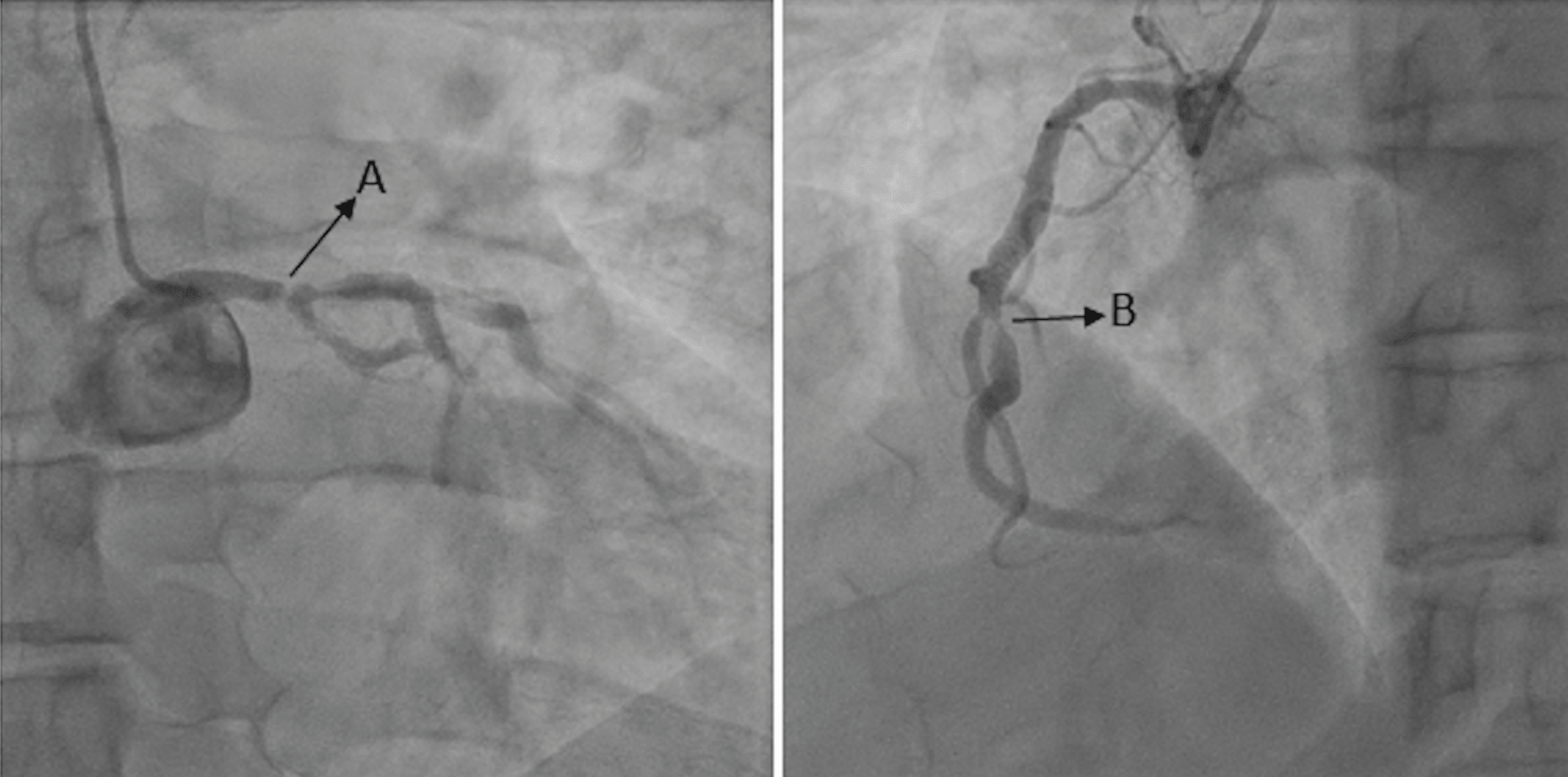 Cureus Negative Stress Test Is Not Always Negative Revisiting the Clinical Implications of