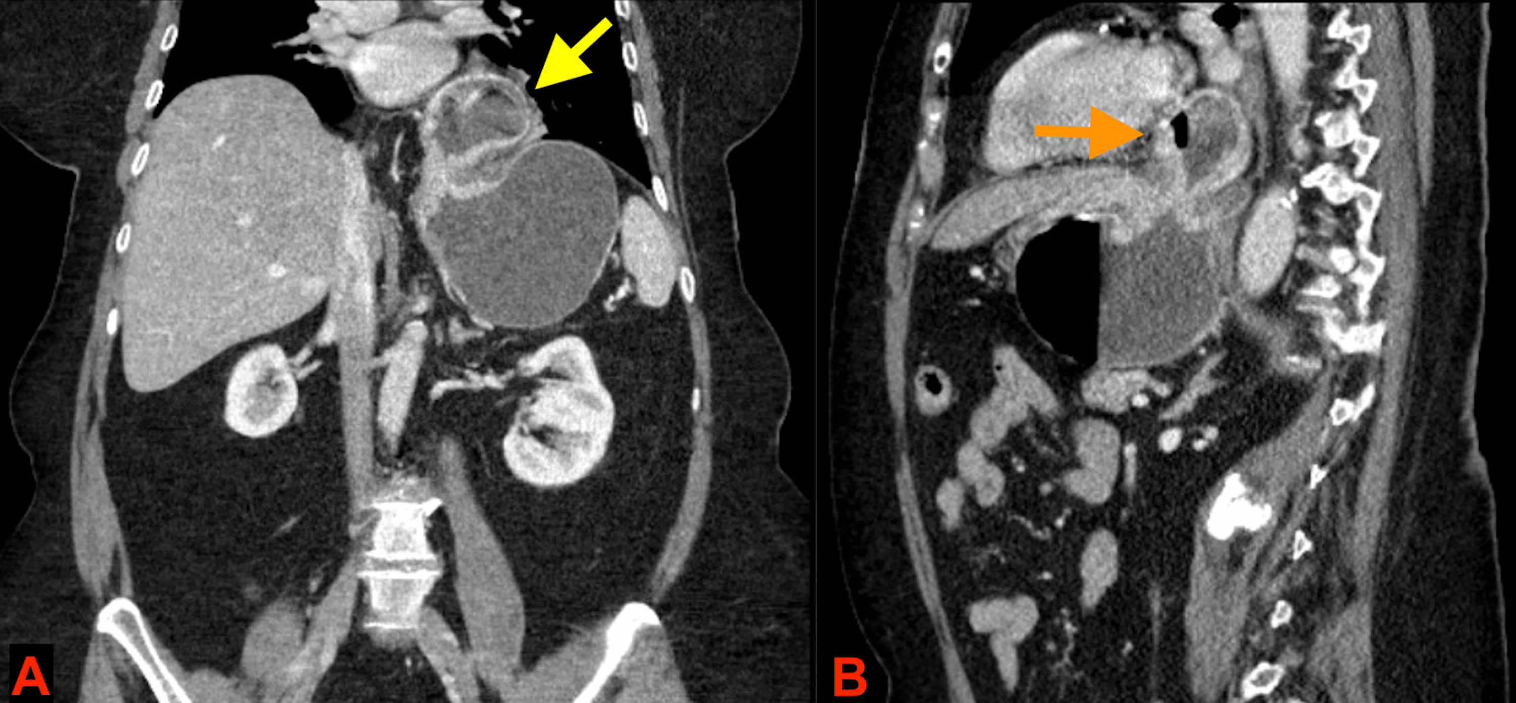 paraesophageal hernia with gastric volvulus