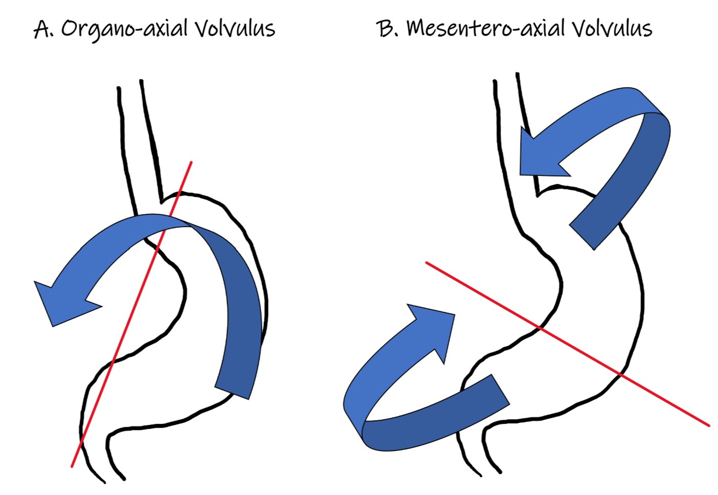 paraesophageal hernia with gastric volvulus