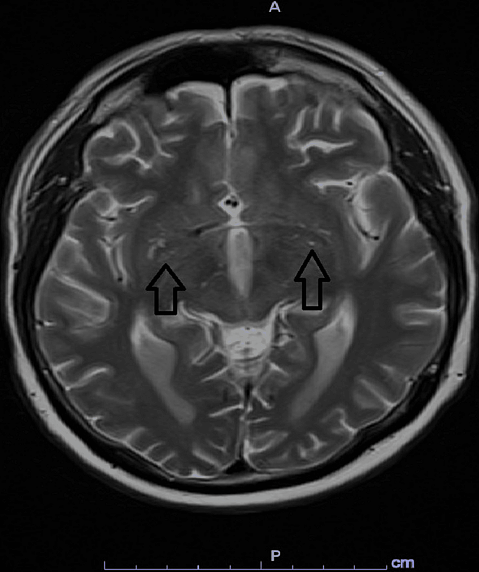 A-T2-MRI-without-evidence-of-injury-or-leptomeningeal-enhancement.