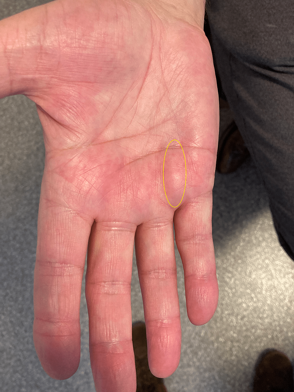 what-is-dupuytren-s-contracture-dupuytren-s-causes-40-off