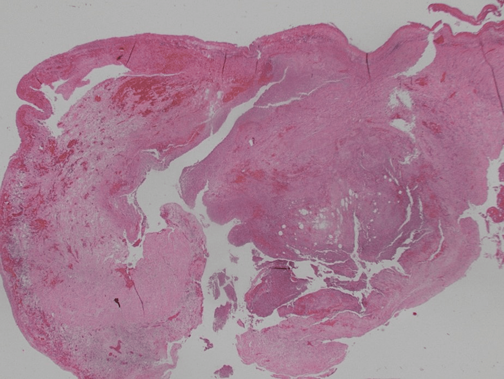 Diverticulitis and Diverticulosis of the Appendix A Case Series Cureus