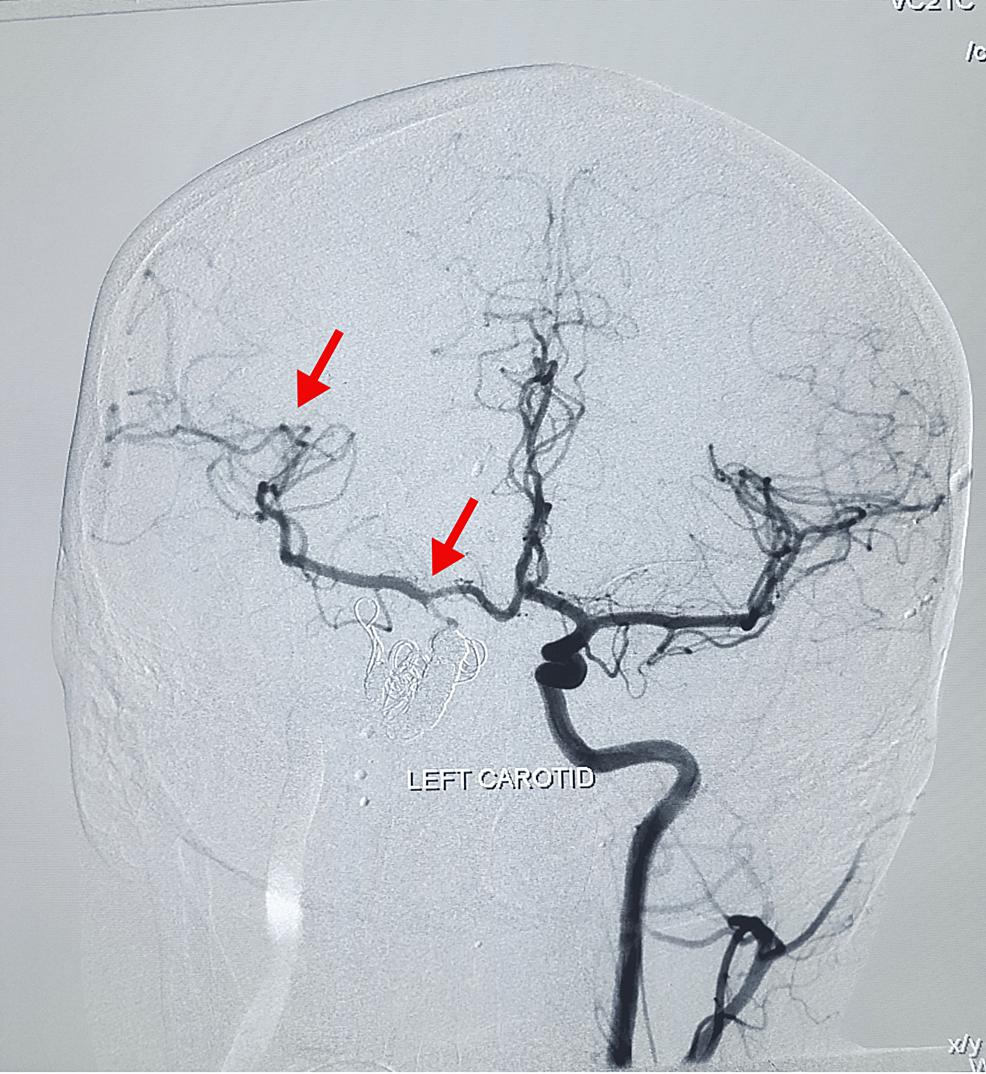 Digital-subtraction-angiography-left-carotid-showing-alternate-blood-supply-through-left-anterior-communicating-branch-to-the-right-cerebrum
