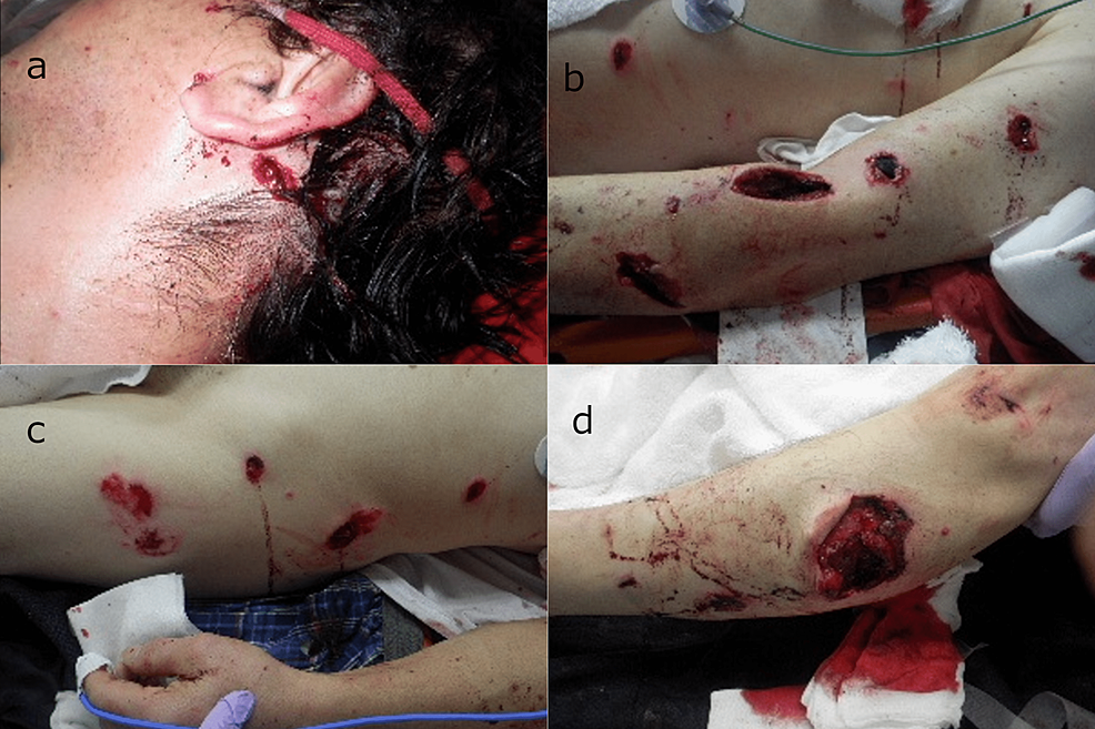 Cureus Blast Injuries By An Improvised Explosive Device In Japan A Case Report