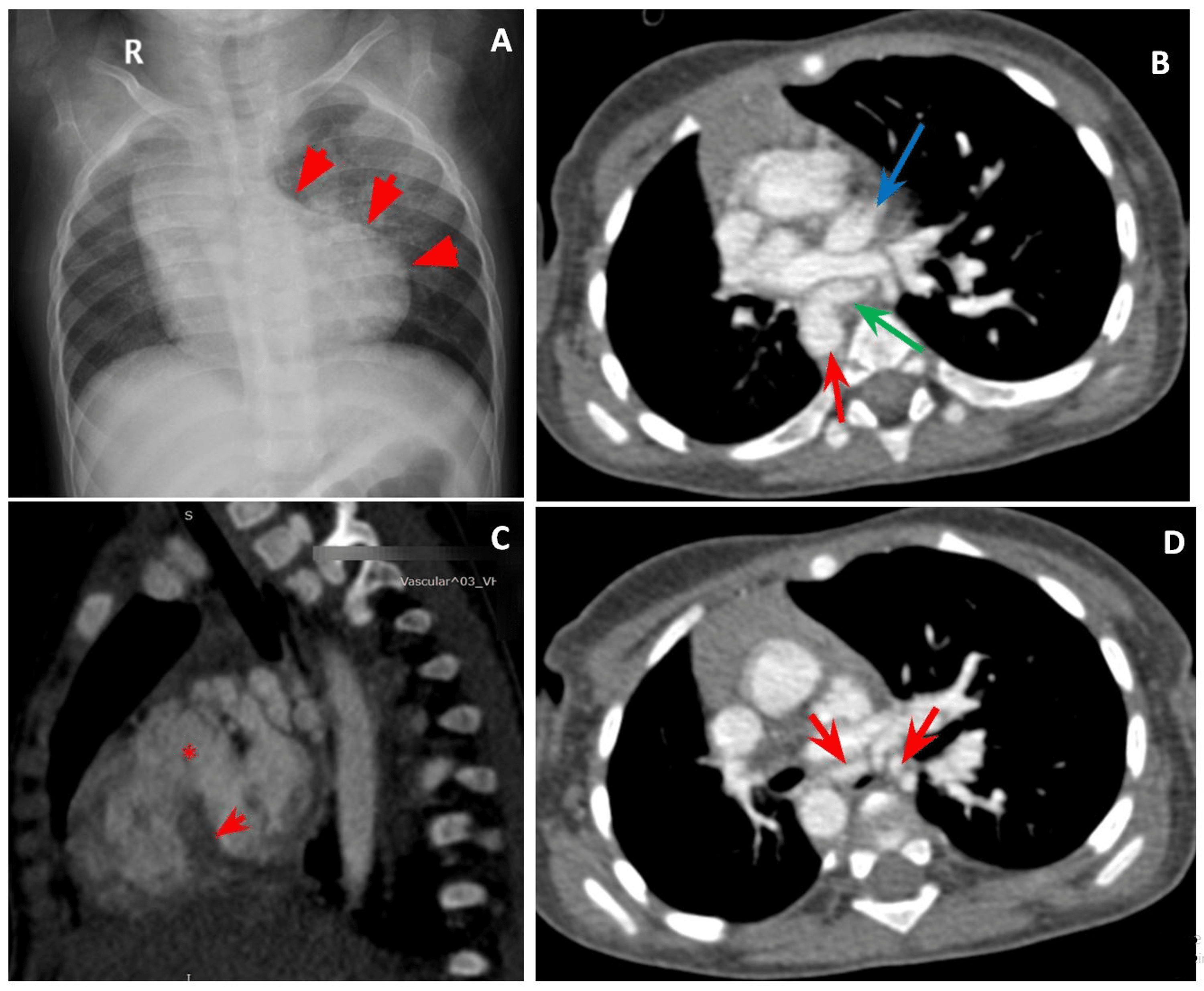 Cureus Proximal Interruption of Pulmonary Artery Spectrum of
