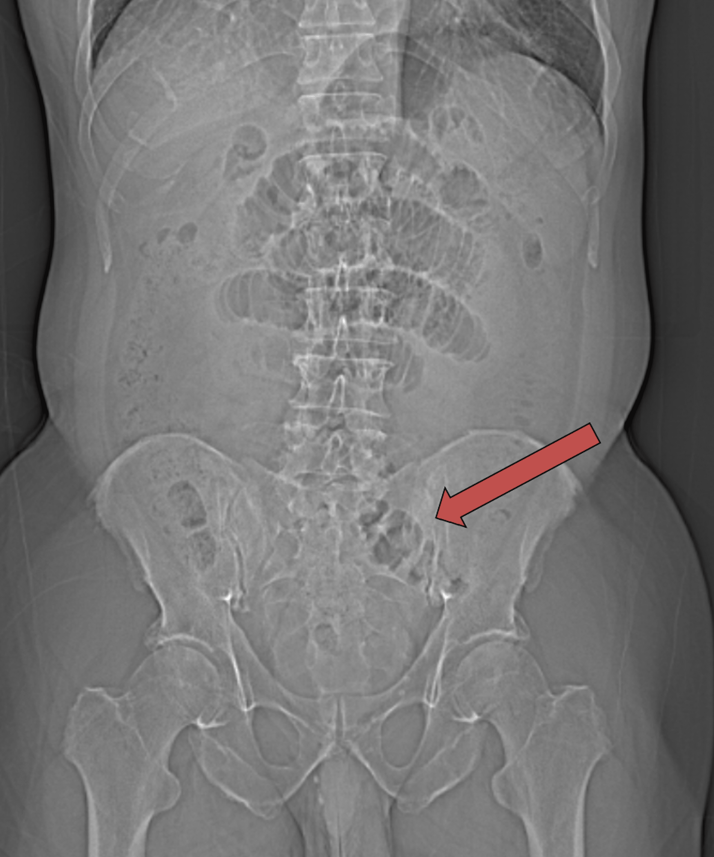 Cureus | Laparoscopic Repair of Small Bowel Obstruction Caused by an ...