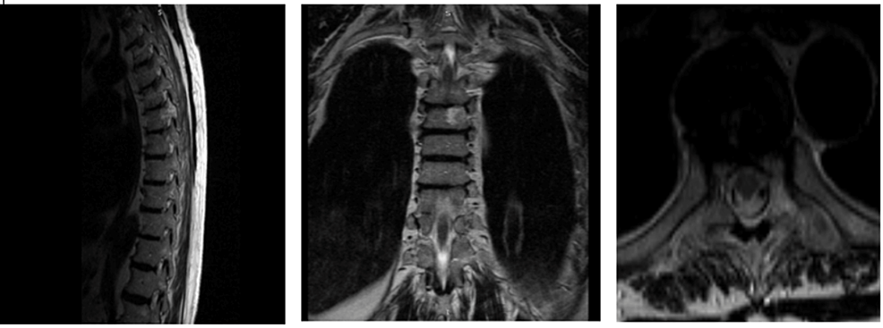 Cureus, Thoracic Percutaneous Vertebroplasty for the Treatment of  Vertebral Hemangioma in a Patient With Forestier's Disease: A Case Report