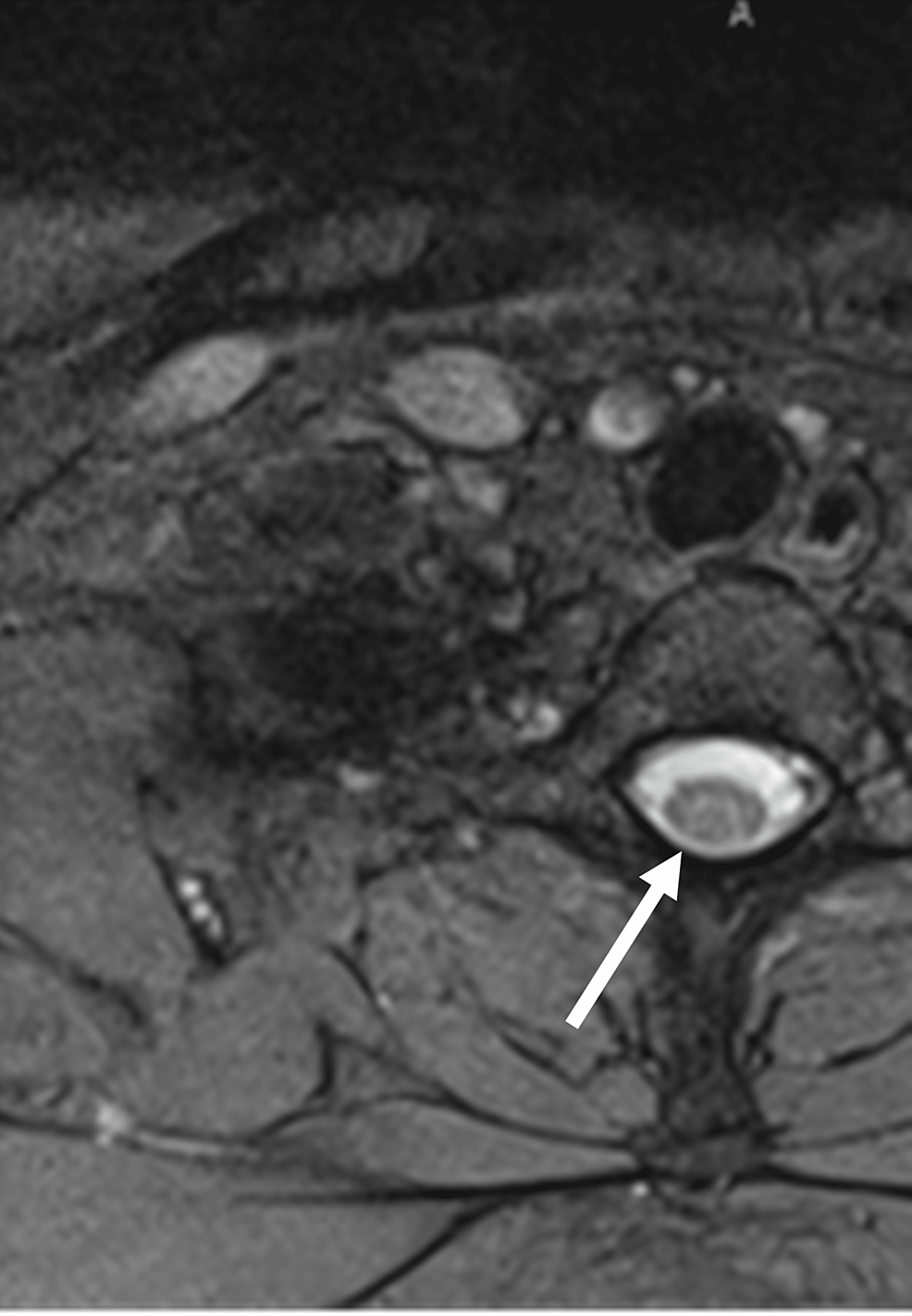 Cureus Subacute Combined Degeneration of the Spinal Cord A