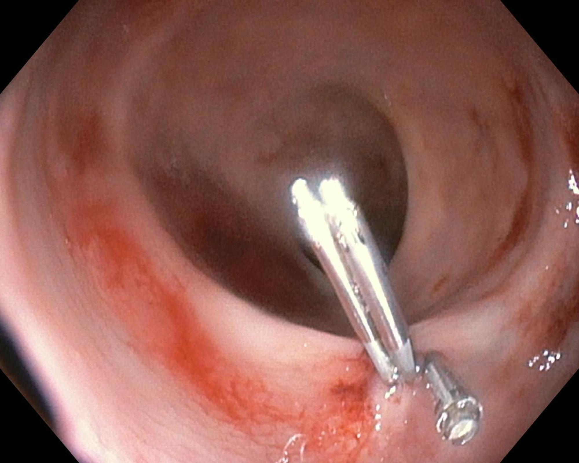 Cureus A Bleeding Dieulafoys Lesion