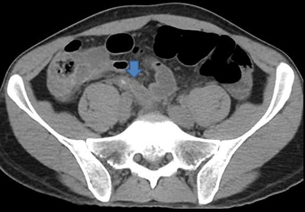 Acute Appendicitis With Localized Peritonitis Without Perforation Or Gangrene