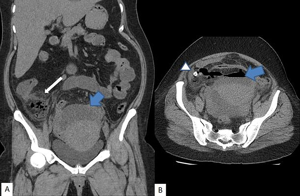 Cureus Accuracy Of Computed Tomography In Differentiating Perforated