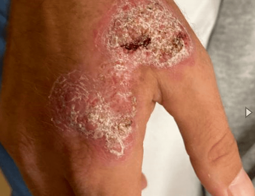blastomycosis skin lesions