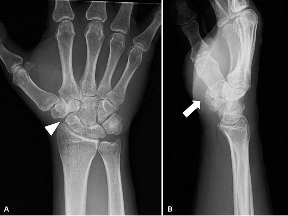 Standard X-ray one year after the operation.