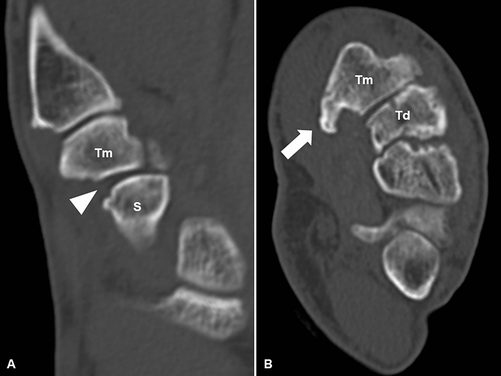 Simple computed tomography one year after the operation.