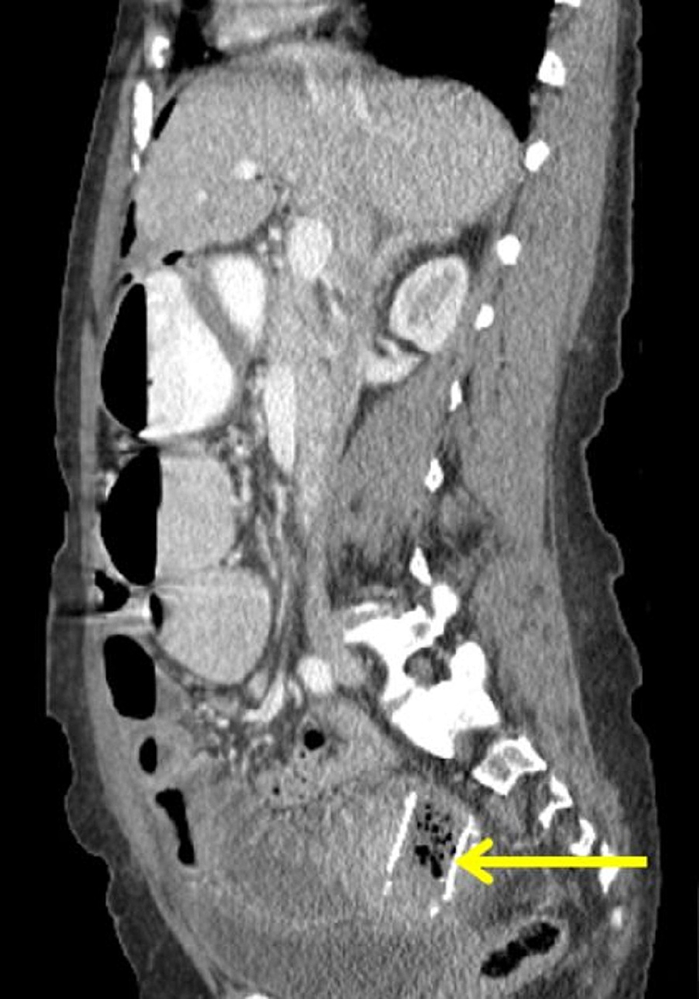 Cureus | Small Bowel Perforation Secondary to Esophageal Stent ...